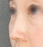 鼻整形の症例写真