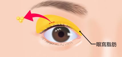 上瞼の眼窩脂肪切除のイメージ