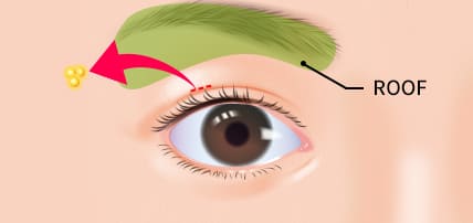 上瞼のROOF切除のイメージ