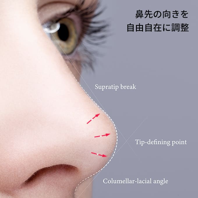 鼻整形の糸であるNDで鼻尖形成・鼻柱下降を行う際の鼻先の向きの調整