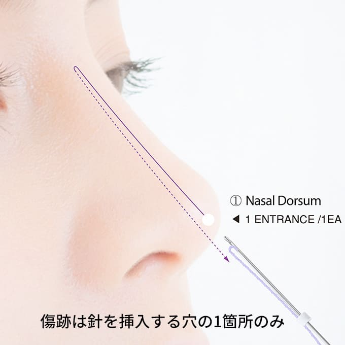 鼻整形の糸であるNDを皮膚に通すイメージ