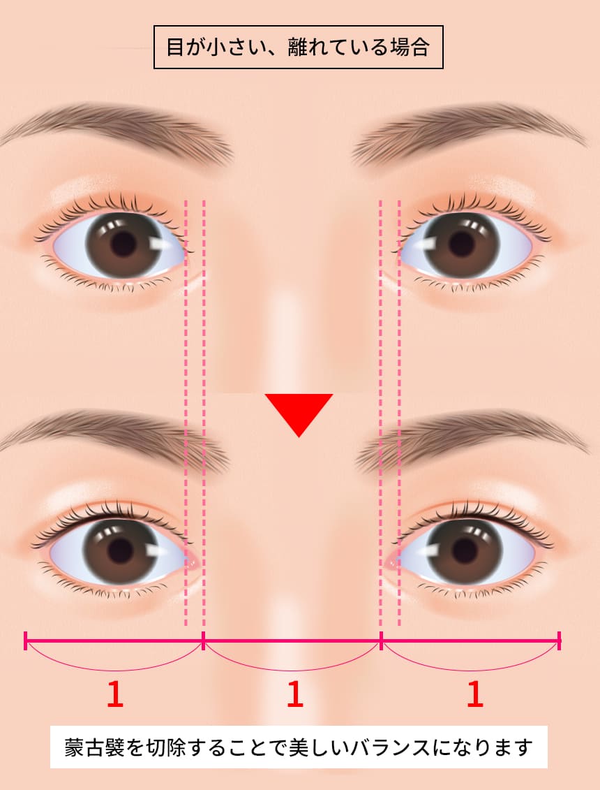目頭切開 - カンナム美容外科