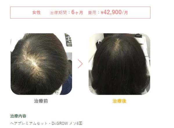 B&Hメディカルクリニックヘアプレミアムセット・Dr.GROW メソ6回(女性）