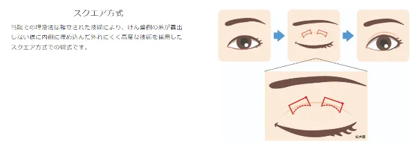 おだくらクリニックの二重整形・埋没法の紹介