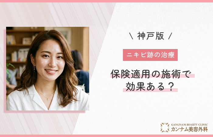 ニキビ跡の治療は保険適用の施術で効果ある？
