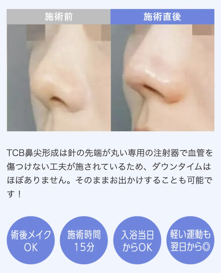 TCBの鼻整形の症例写真と施術内容