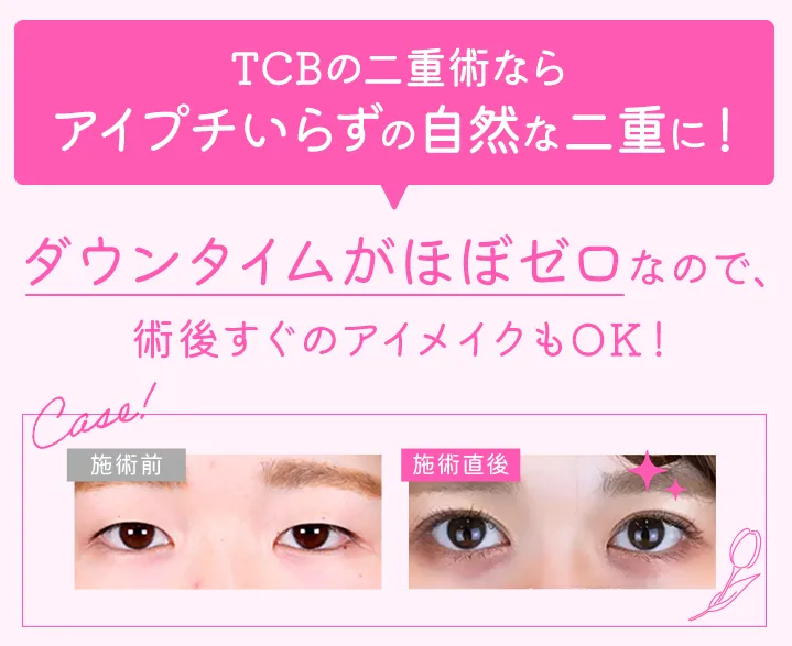 TCBの二重術(埋没法)ならアイプチいらずの自然な二重に！