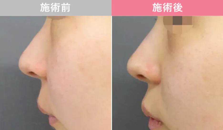 TCBメッシュ鼻整形症例写真