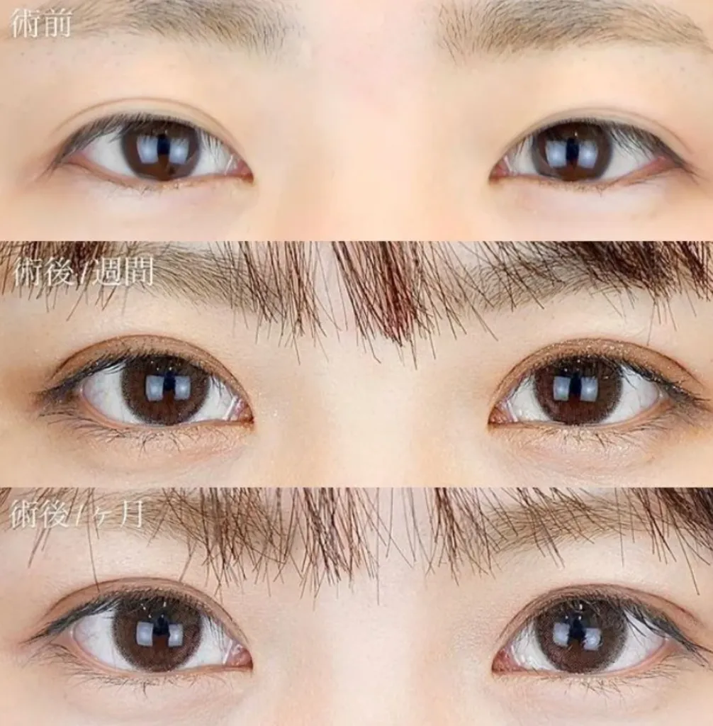 TCB二重整形施術症例