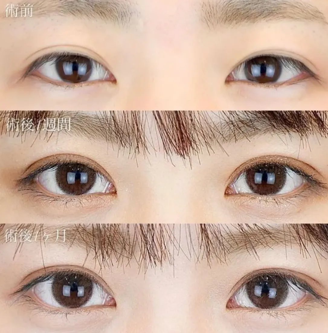 TCB二重整形施術症例