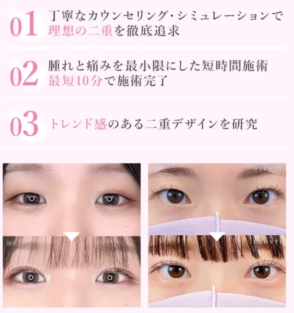 TCBの二重整形の特徴