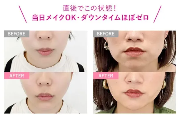 糸リフト直前と直後