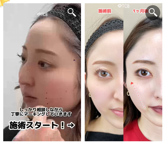TCBの糸リフトカウンセリングはとても丁寧で安心できる
