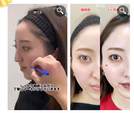 TCBなら傷跡が気にならない糸リフトが受けられる