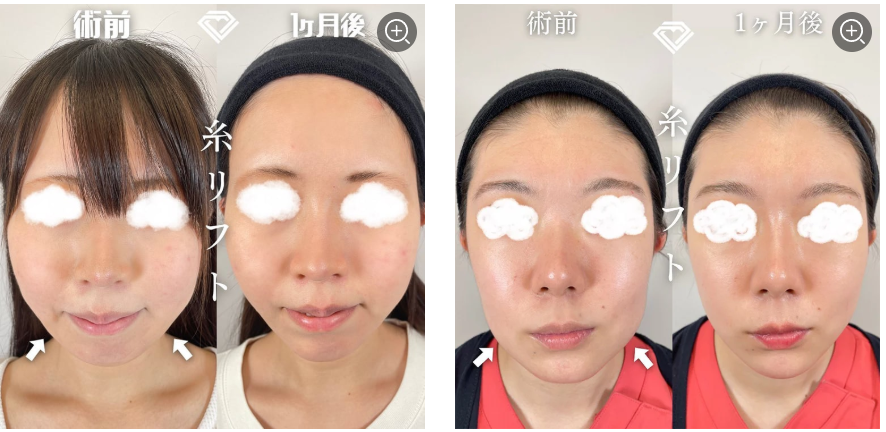 TCBの糸リフトの症例写真2