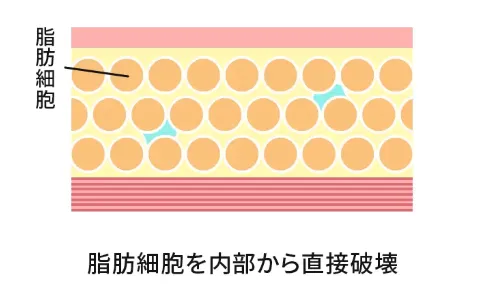 スルリム注射は脂肪細胞を内部から直接破壊