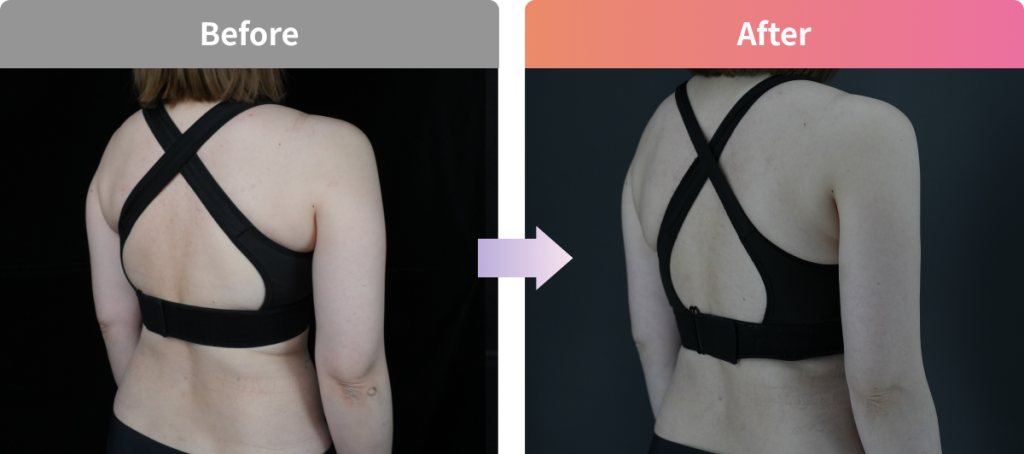 スルリム注射の広背部のBefore・After写真