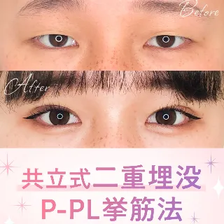 共立美容外科の共立式二重P-PL挙筋法