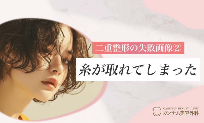 二重整形の失敗画像②糸が取れてしまった