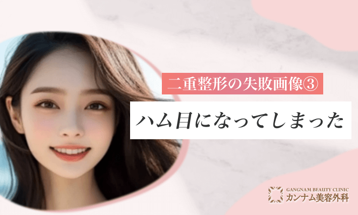 二重整形の失敗画像③ハム目になってしまった