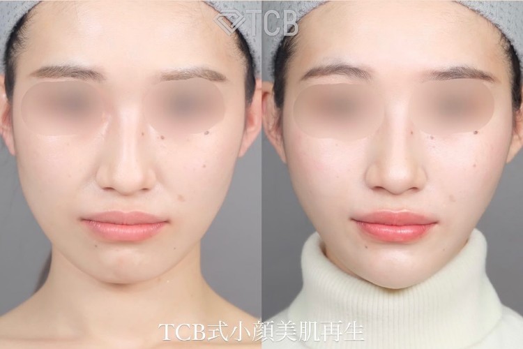 TCB糸リフト（小顔美肌再生）
