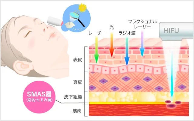 TCB　ハイフ説明