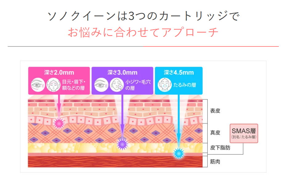 TCB　ソノクイーン仕組み