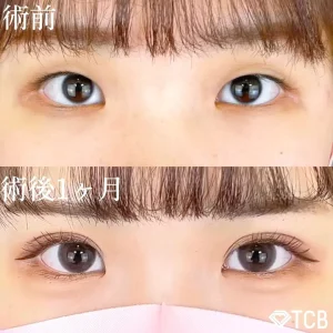 TCB公式ホームページにはたくさんの症例写真があり、理想の二重の幅をイメージしやすい