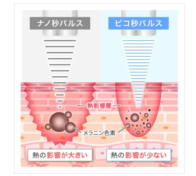 ピコレーザーはダウンタイムも短い治療法
