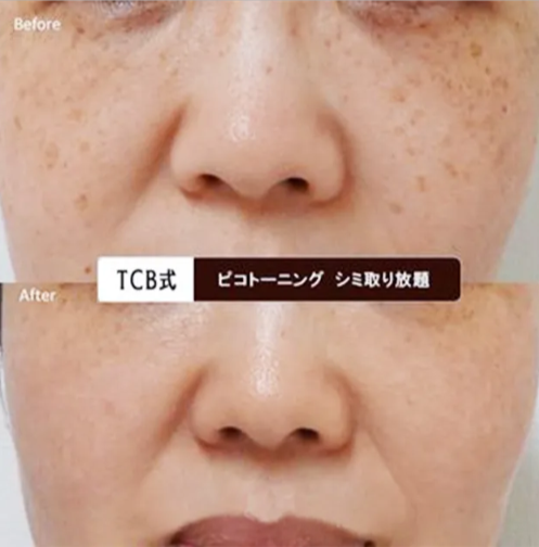 おすすめクリニックTCB東京中央美容外科のシミ取り症例写真