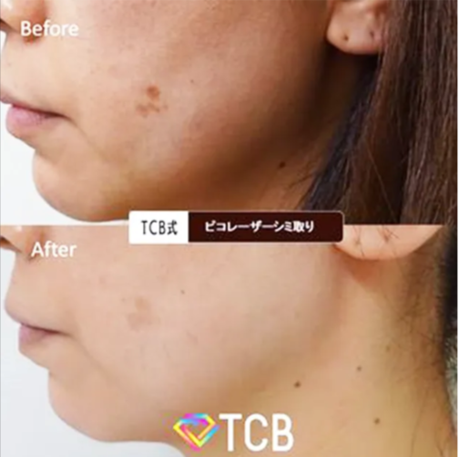 シミ取りでおすすめのTCB東京中央美容外科のピコレーザーによる症例写真