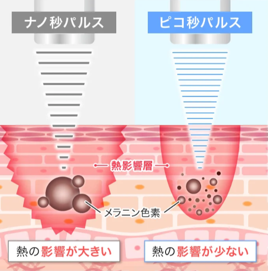 シミ取りでおすすめのTCB東京中央美容外科ピコレーザーの仕組み