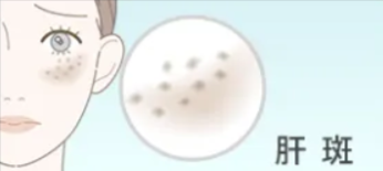 肝斑