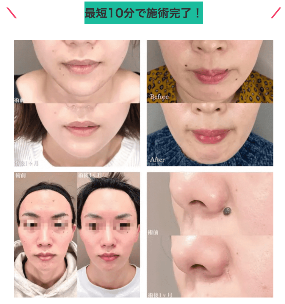 TCB東京中央美容外科ほくろ除去画像