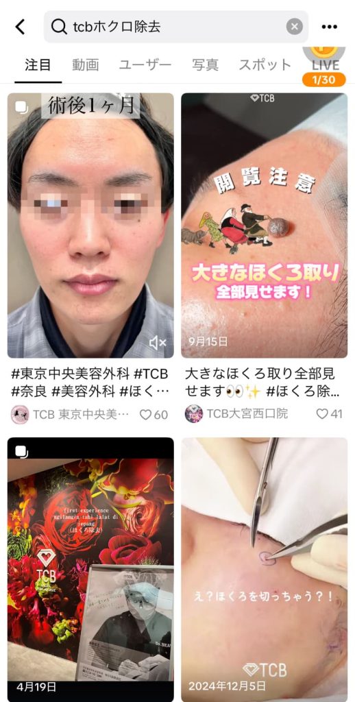 TCBの症例は、動画で見れるためイメージが湧きやすい