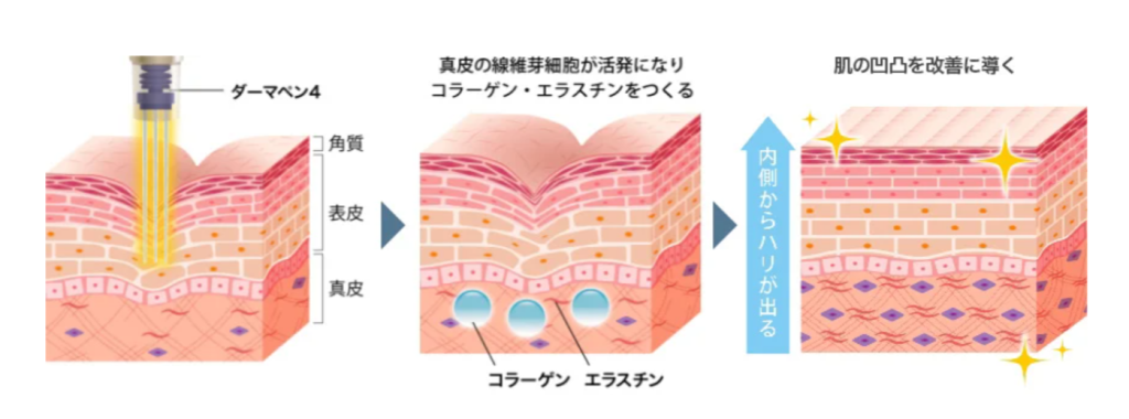口コミの良いTCBのダーマペン