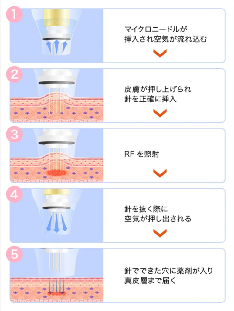口コミ好評TCBポテンツァの仕組み