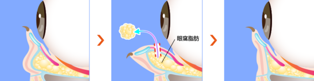 口コミの良いTCBの目の下のふくらみ取り