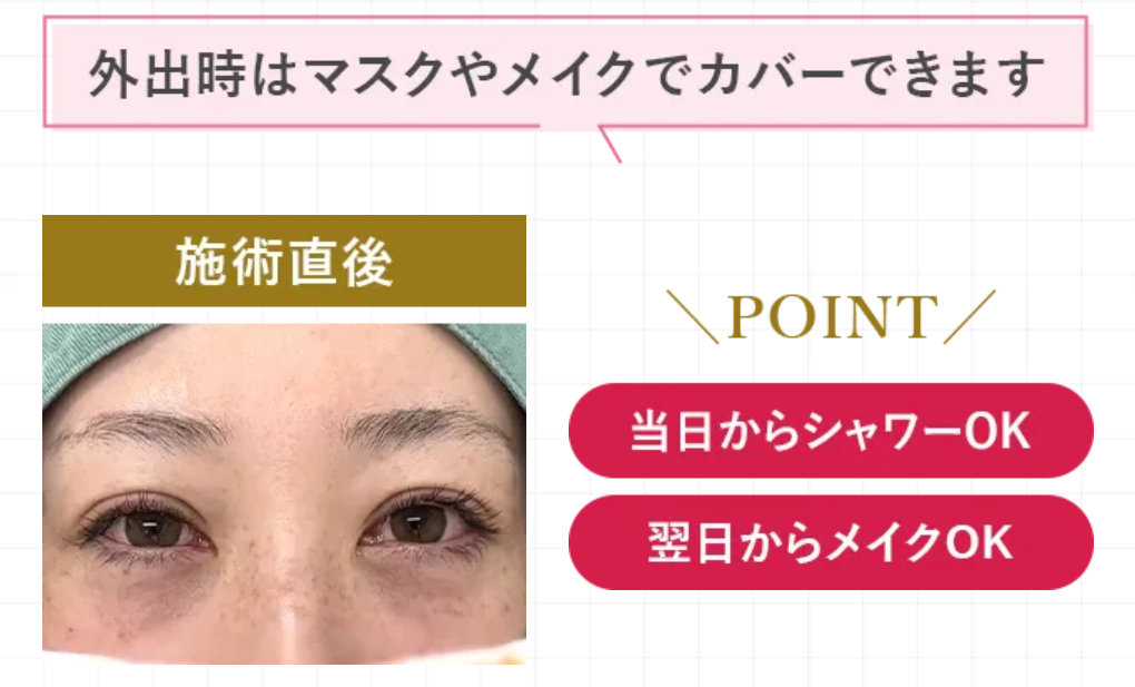 口コミ好評のTCBの目の下のふくらみ取りダウンタイム