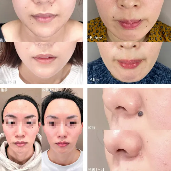 口コミが良いTCBのほくろ除去の症例画像