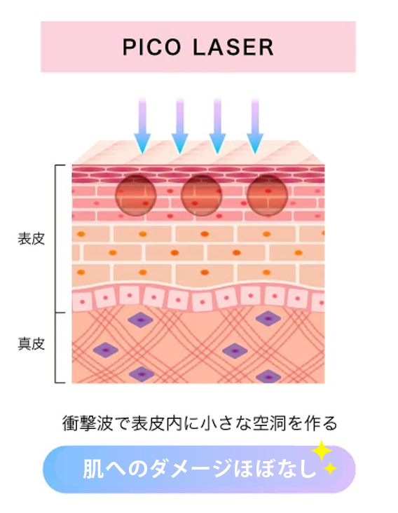TCBのニキビ治療のピコレーザー画像
