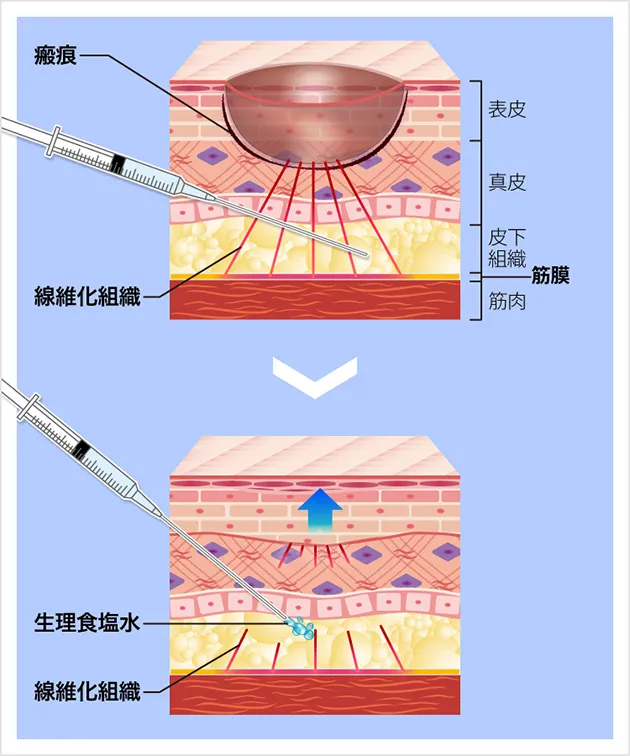 TCBのニキビ治療のサブシジョン画像