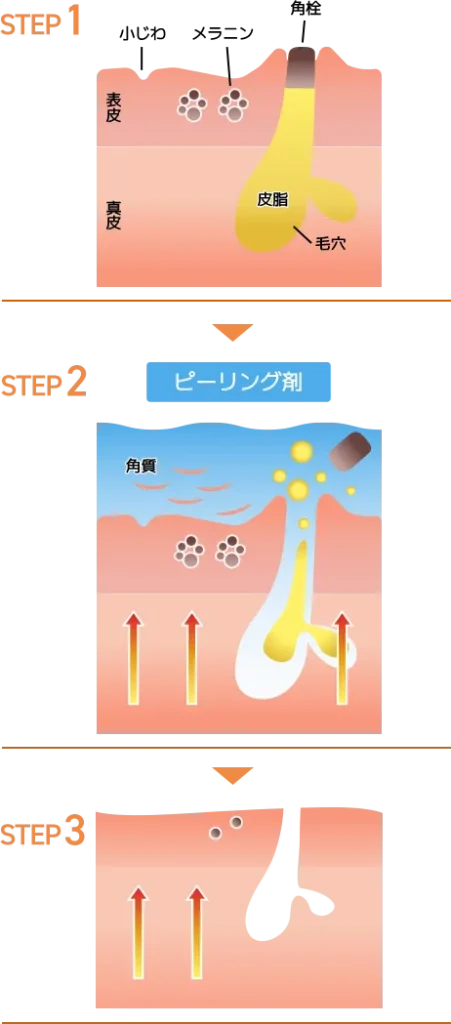 TCBのニキビ治療のハイドラジェントル画像