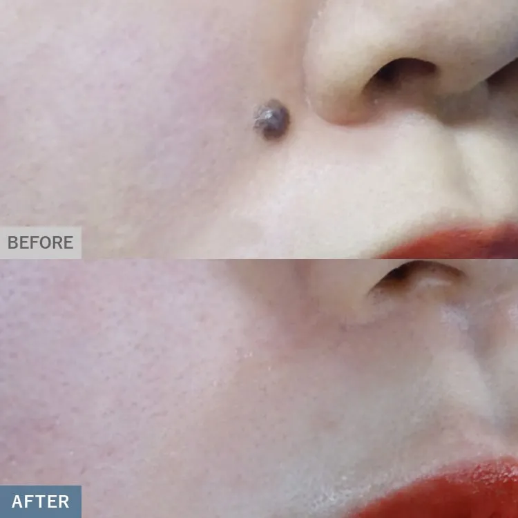 口コミが良いTCBのほくろ除去の症例画像1