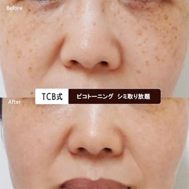 TCBでシミ取り放題 症例