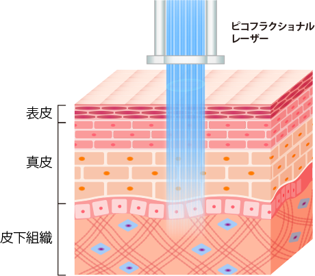 TCBピコレーザーのピコフラクショナル