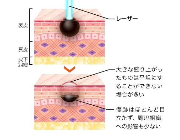 口コミが良いTCBのほくろ除去のレーザー治療画像