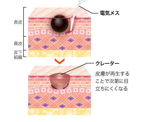 口コミが良いTCBのほくろ除去の電気分解法画像