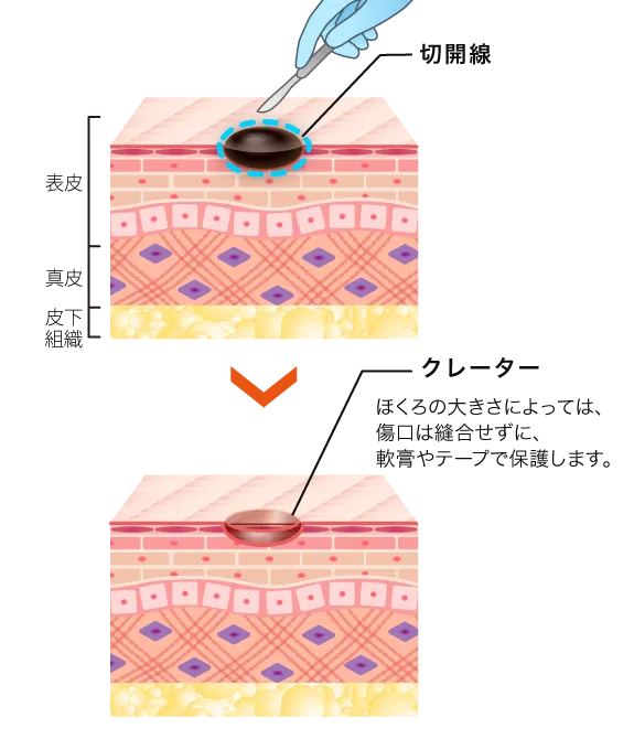 口コミが良いTCBのほくろ除去のくり抜き法画像