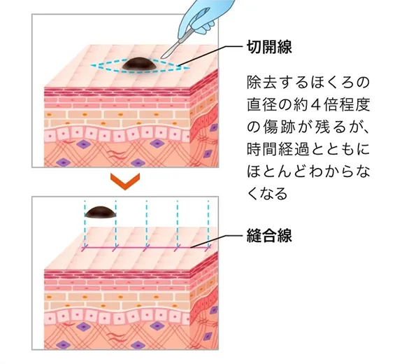 口コミが良いTCBのほくろ除去の切開法画像
